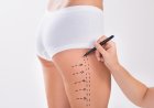 Must-Know Insights for Your Liposuction Surgery Consultation in Dubai