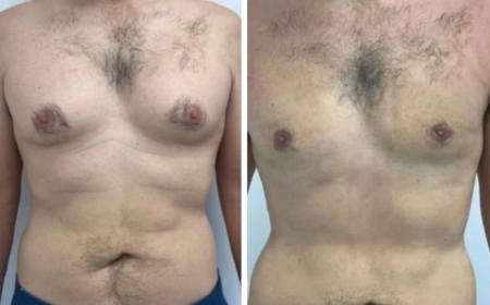 Natural Results from Gynecomastia Surgery in Dubai: How Top Surgeons Achieve Them
