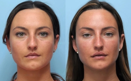 Choosing the Best Plastic Surgeons in Dubai for Thread Lift Success