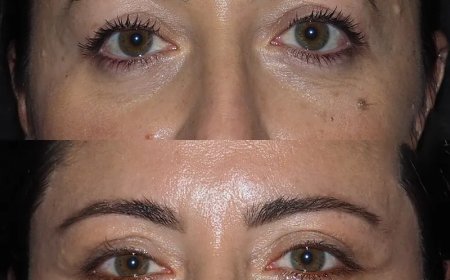 Who Is a Good Candidate? Find Out from the Best Eye Bag Removal Surgeon in Dubai