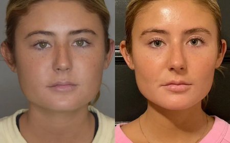 How to Maintain Facial Volume After Buccal Fat Removal with the Best Buccal Fat Removal Surgeon in Dubai