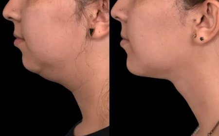 How Double Chin Removal Surgery Can Help You Achieve Your Aesthetic Goals with the Best Double Chin Removal Surgeon in Dubai