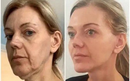 Advance Your Look with Profhilo by Best Plastic Surgeons in dubai