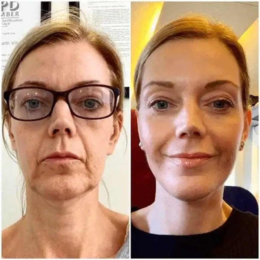 Refresh Texture via Profhilo Treatments in Dubai