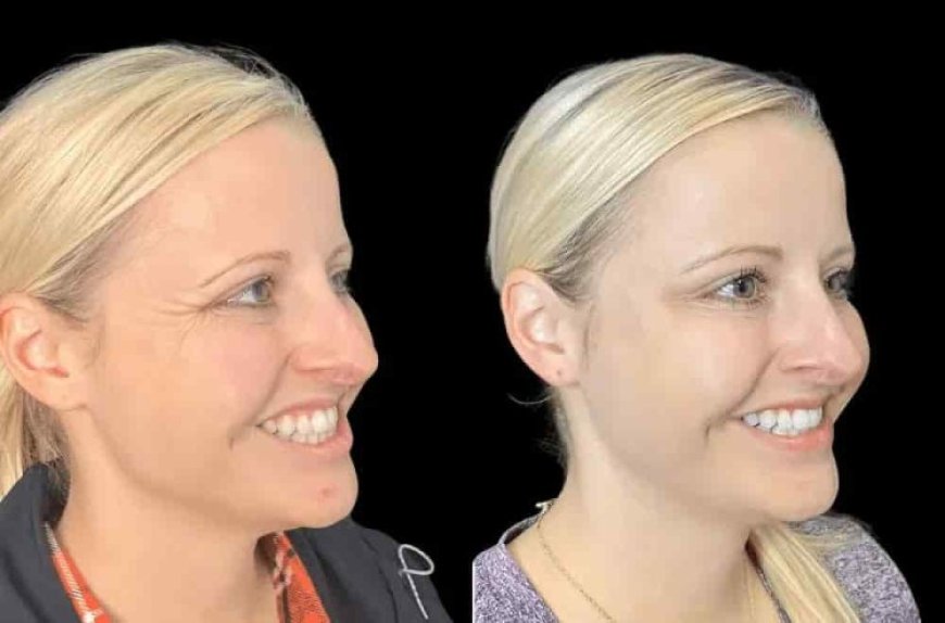 How Botox Treatments in Dubai Are Transforming Modern Aesthetics