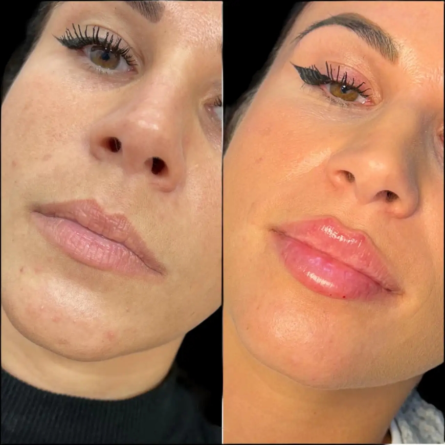 Discover the Best Doctors in Dubai for Fillers Treatments