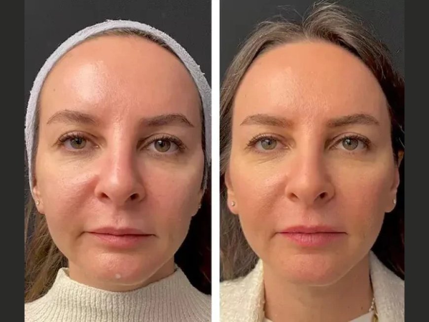 Best Doctors in Dubai for Mesotherapy: What Sets Them Apart?