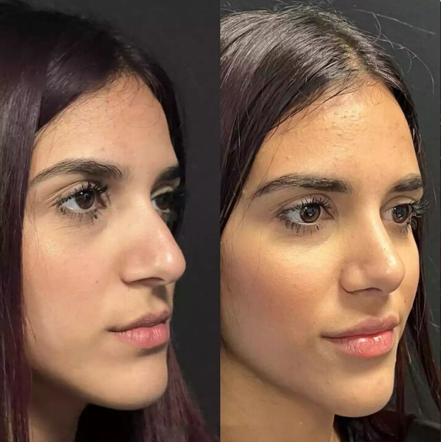 Best Septoplasty Surgeon in Dubai: Safe Hands for Complex Cases