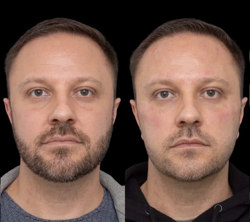 How the Best Doctors in Dubai Provide Comprehensive Care for Under Eye Fillers