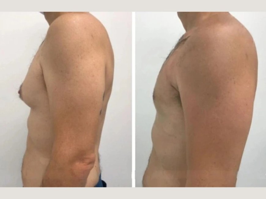 The Best Gynecomastia Surgeons in dubai: Why They’re the Top Choice for Male Breast Surgery