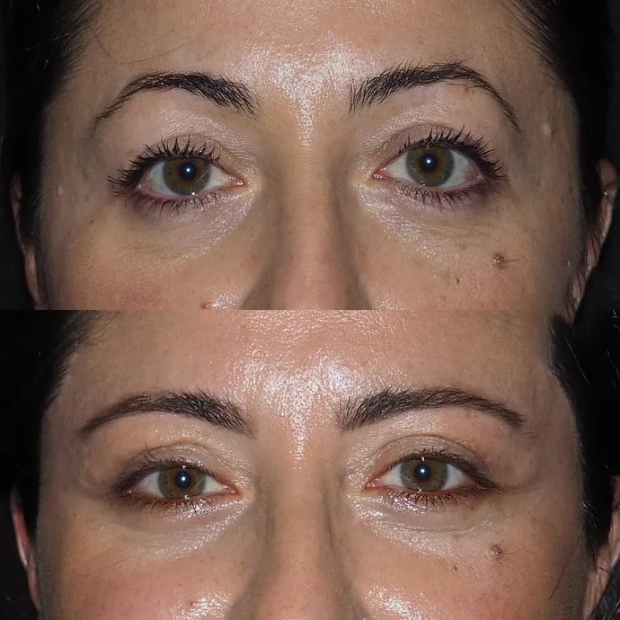Who Is a Good Candidate? Find Out from the Best Eye Bag Removal Surgeon in Dubai