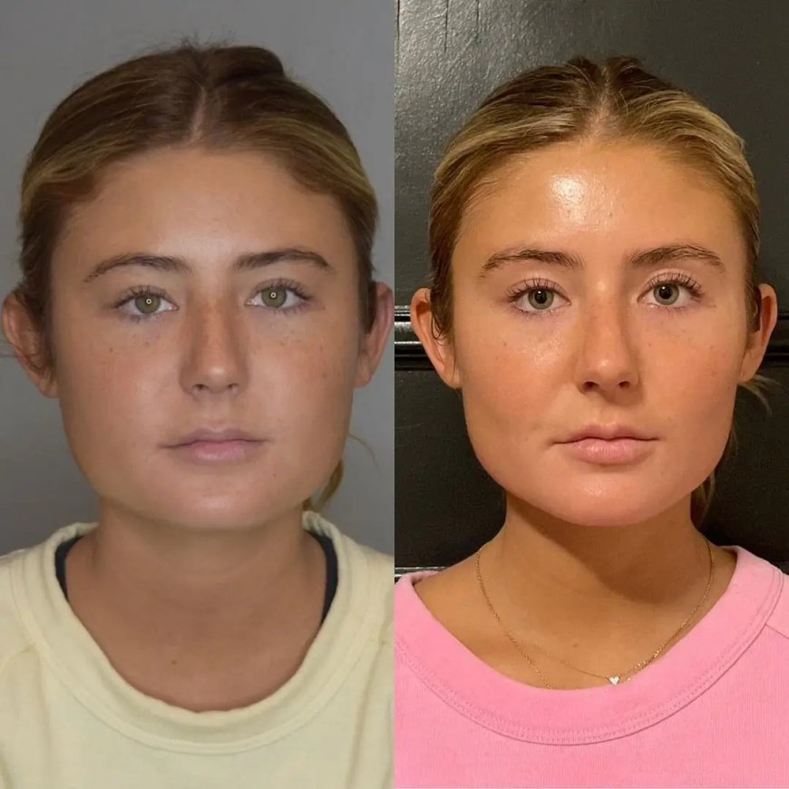 How to Maintain Facial Volume After Buccal Fat Removal with the Best Buccal Fat Removal Surgeon in Dubai