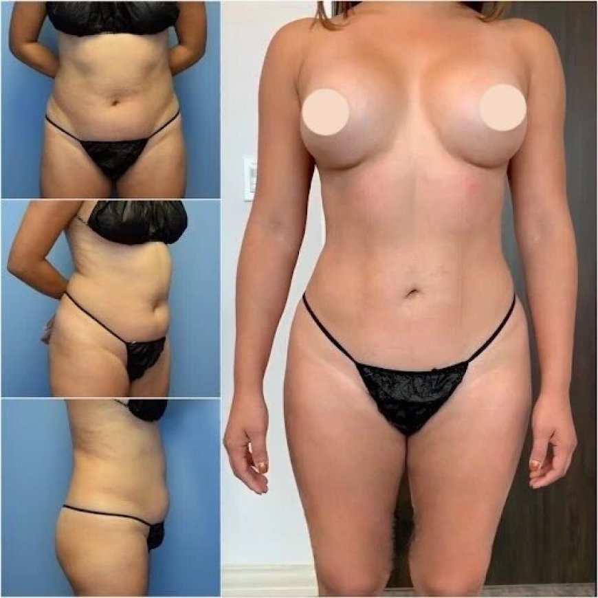 Get a Youthful, Defined Look with Body Contouring in Dubai