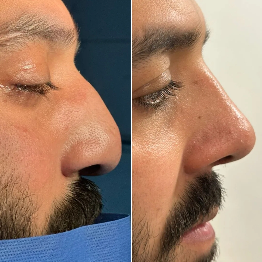 Planning for Rhinoplasty in Islamabad: Budget, Procedure, and Aftercare