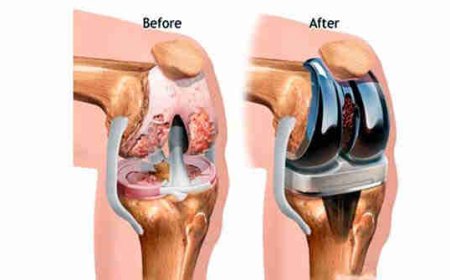 Discover the Best Knee Replacement Surgeon in Delhi: Dr. Nikhil Verma