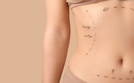 Global Liposuction Surgery Devices Market to Reach US$ 5.24 Billion by 2033, Fueled by Rising Demand for Aesthetic Procedures and Technological Advancements