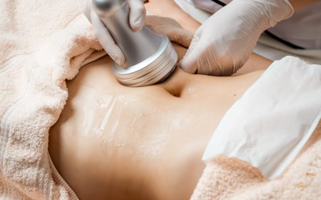 Liposonix for Belly Fat: Targeting Your Trouble Zones