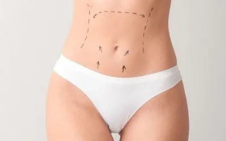 Do I Need to Stay Overnight After a Mini Tummy Tuck in Dubai?