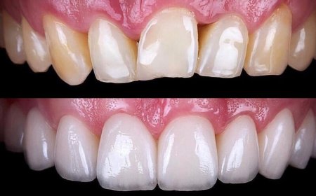 Can Veneers in Dubai Be Removed Later If I Change My Mind?