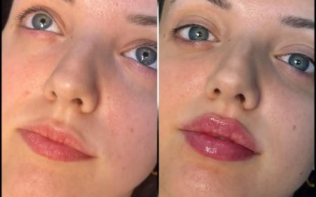 Under Eye Fillers Treatments by the Best Doctors in dubai