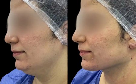 The Best Aesthetic Clinics in Dubai for Chin Fillers: A Sculpted Jawline Awaits