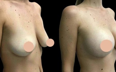 Is Breast Augmentation Right for You Expert Advice from the Best Breast Augmentation Surgeon in Dubai