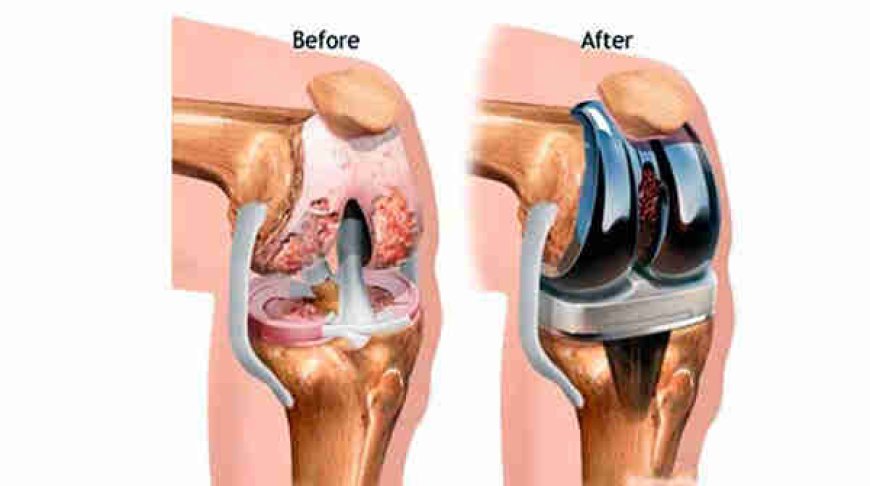 Discover the Best Knee Replacement Surgeon in Delhi: Dr. Nikhil Verma