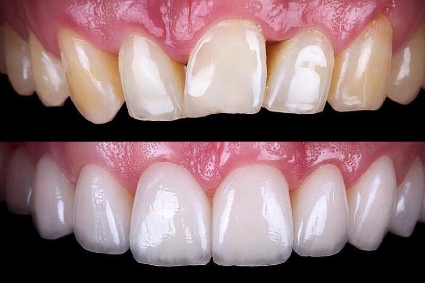 Can Veneers in Dubai Be Removed Later If I Change My Mind?