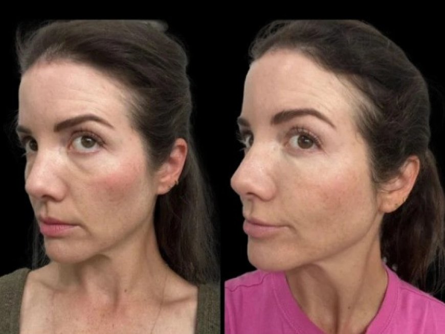 How the Best Doctors in Dubai Ensure Safe and Long-Lasting Results for Dark Circles