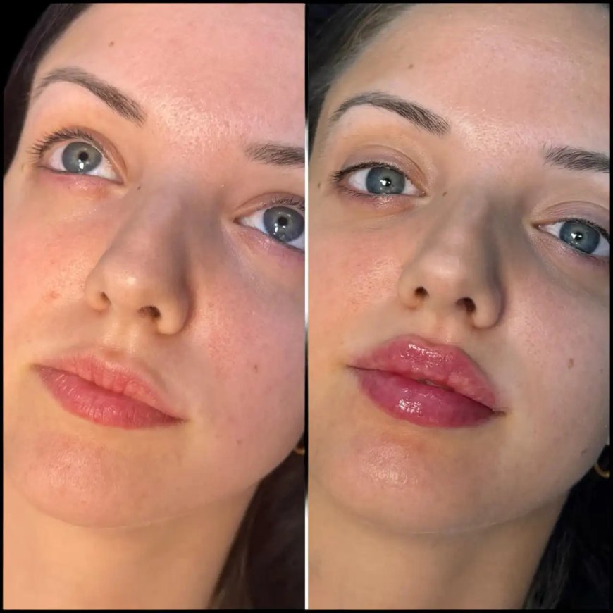 Under Eye Fillers Treatments by the Best Doctors in dubai