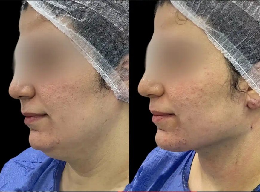 The Best Aesthetic Clinics in Dubai for Chin Fillers: A Sculpted Jawline Awaits